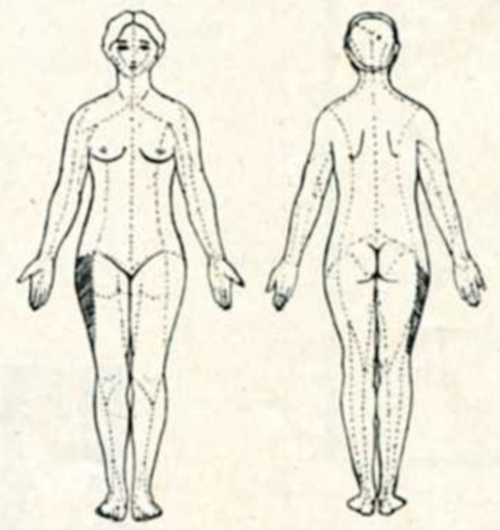 Болезнь Рота-Бернгардта